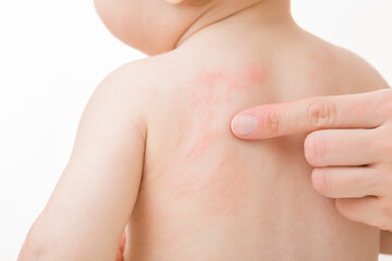Young adult mother finger pointing to red rash on infant back. Baby boy isolated on light gray background. Allergy from food, milk formula or mother milk. Skin problem. Closeup.