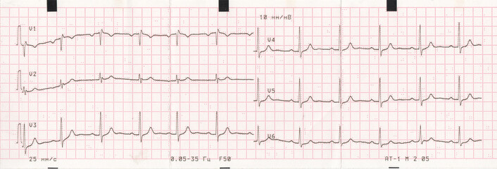 Patient's cardiogram, heartbeat graph. Medicine for people