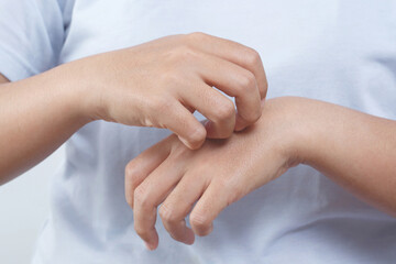 Fototapeta na wymiar Health problems, woman has itchy hands