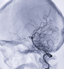 Cerebral angiography  imageor potesterior cerebral artery from Fluoroscopy in intervention radiology  showing cerebral artery.