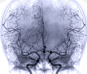Cerebral angiography  image from Fluoroscopy in intervention radiology  showing cerebral artery. - obrazy, fototapety, plakaty