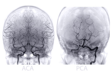 Cerebral angiography  image from Fluoroscopy in intervention radiology  showing cerebral artery. - obrazy, fototapety, plakaty