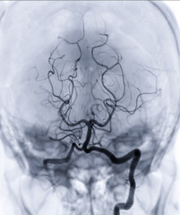 Cerebral angiography  imageor potesterior cerebral artery from Fluoroscopy in intervention radiology  showing Basilar artery. - obrazy, fototapety, plakaty