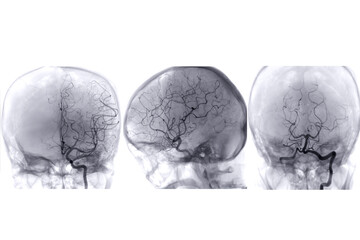 Cerebral angiography  image from Fluoroscopy in intervention radiology  showing cerebral artery.