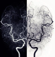 Cerebral angiography  image from Fluoroscopy in intervention radiology  showing cerebral artery.