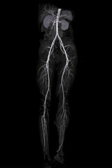 CTA femoral artery run off showing  femoral artery for diagnostic  Acute or Chronic Peripheral Arterial Disease.