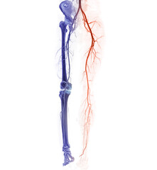 CTA femoral artery run off showing  femoral artery for diagnostic  Acute or Chronic Peripheral...