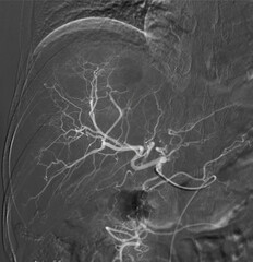 Imaging of TACE or Chemoembolization is a procedure that allows a dose of chemotherapy drugs to be...