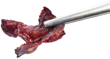 Thick blood tissue with forceps