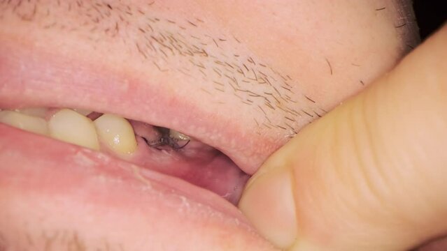 Seam put with black threads on gum of male patient. Man opens mouth showing result of implant placement in dental clinic extreme closeup