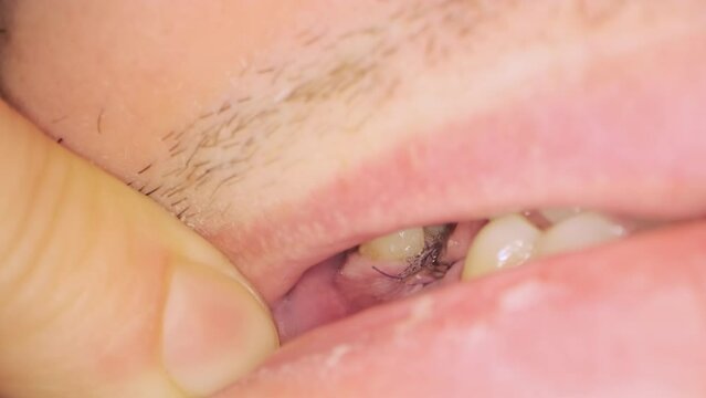 Black threads on gum in oral cavity of male patient after tooth implantation in dental clinic. Man opens mouth showing seam extreme closeup