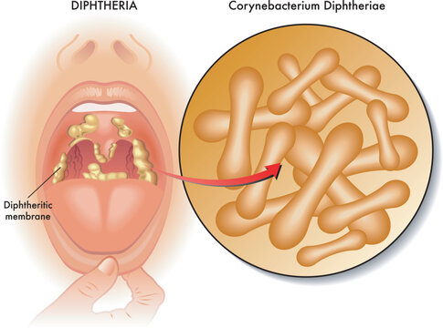 Medical illustration of symptoms of diphtheria, with annotations. 