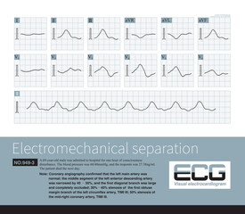 Electromechanical separation is a kind of terminal ECG. The patient's ECG has electrical signals, the ECG wave is widened with morphological abnormalities, and the ventricle has no contraction.