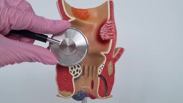 Anus anatomy and bowel treatment doctor with stethoscope. Treatment and diagnosis of diseases of the rectum hemorrhoids