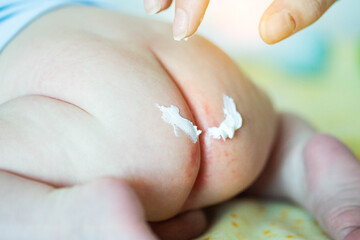 The mother applies a healing cream to the baby's red bottom. Healing ointment for diaper rash,...