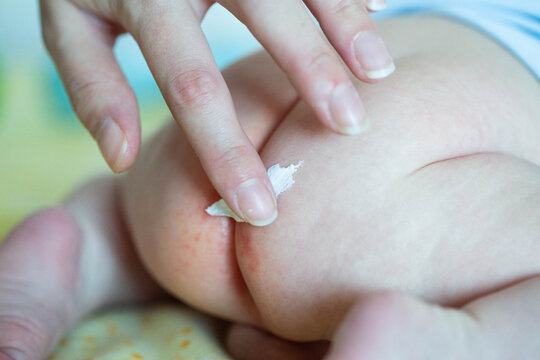 The mother applies a healing cream to the baby's red bottom. Healing ointment for diaper rash, irritation and redness on the delicate skin of a baby, close-up