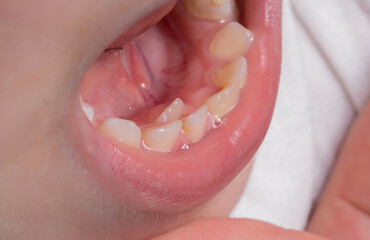 A child's tooth grows second next to the milk teeth. Formation of the jaw and permanent teeth in...