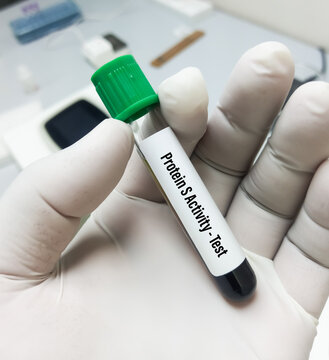 Blood Sample For Protein S Activity Test To Diagnosis Of Coagulation Disorder. Pulmonary Embolism. Protein S Deficiency.