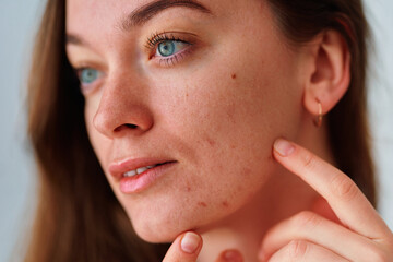 Young woman with problem skin and acne closeup - Powered by Adobe