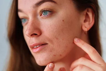 Young woman with problem skin and acne closeup © Goffkein
