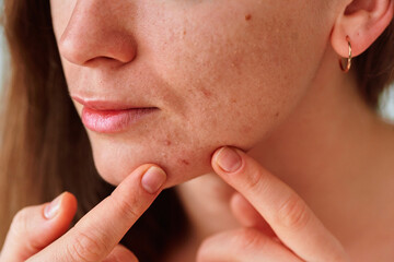 Young woman with problem skin and acne closeup