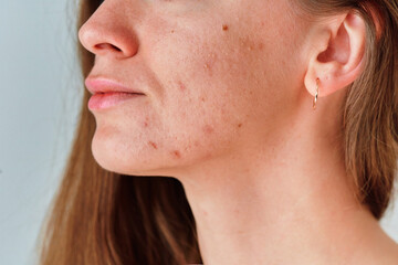 Young woman suffering from problem skin and acne closeup - obrazy, fototapety, plakaty