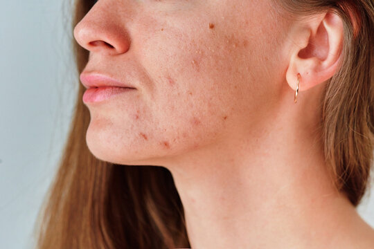 Young woman suffering from problem skin and acne closeup