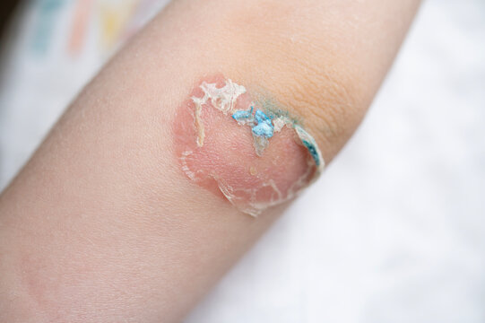 Healing wound on a child's hand. Traces after pyoderma disease. Infectious purulent skin disease in children.