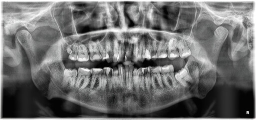 Panoramic Dental X-ray picture - 35 years old male have fourth molar on left side - most of tooths is with a fillings - obrazy, fototapety, plakaty