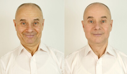 elderly caucasian male face with puffiness under eyes and wrinkles before and after treatment, two...