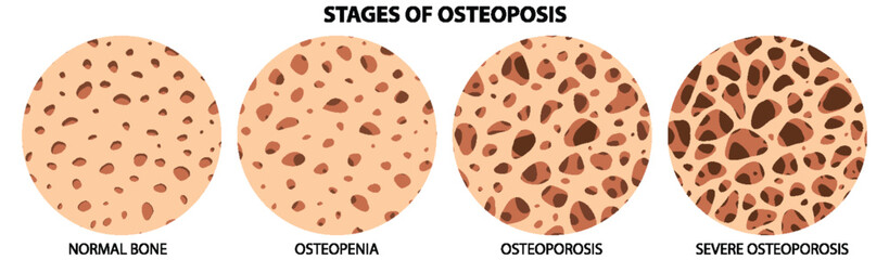 Stages of Osteoposis Vector