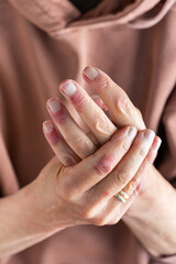 Woman hands with atopic dermatitis, eczema, allergy reaction on skin