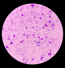 Hereditary hemolytic anemia. Hemoglobin E (HbE) disease. Smear show 90 nRBC100 wbc, pencil cell,...