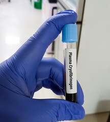 Scientist hold blood sample for Plasma Cryofibrinogen test, to diagnosis of vasculitis,...