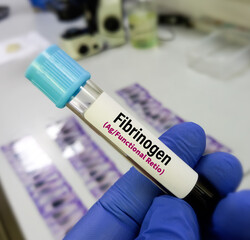 Technologist hold blood sample for fibrinogen Ag/Fungtional retio test, to diagnosis of...