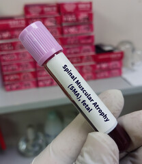 Blood sample for Spinal Muscular Atrophy(SMA), fetal test, It's an autosomal recessive...