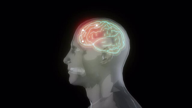 Medical 3d animation - showing a male getting a headache. 3d animation of a man having a headache.