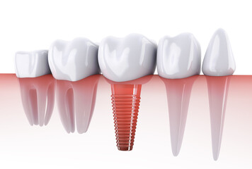 Fototapeta na wymiar Molars and implant in the jaw bone. 3d render.