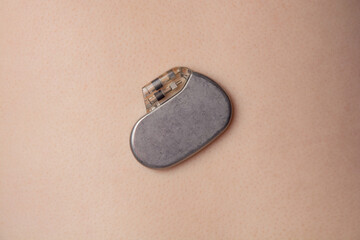 pacemaker on the skin surface