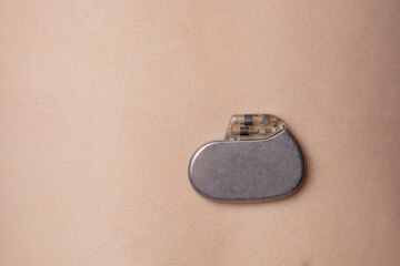 pacemaker on the skin surface