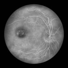 Best vitelliform macular dystrophy, stage 3 Pseudohypopyon, layering of lipofuscin, illustration, fluorescein angiography