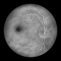 Best vitelliform macular dystrophy, Atrophic stage, retinal atrophy, illustration, fluorescein angiography