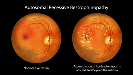 Autosomal recessive bestrophinopathy, illustration showing normal eye retina and accumulation of lipofuscin deposits around and beyond the macula - obrazy, fototapety, plakaty