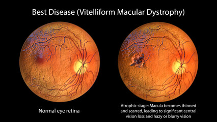Best disease, 3D illustration showing normal eye retina and Best vitelliform macular dystrophy in atrophic stage with retinal atrophy and scar formation - obrazy, fototapety, plakaty