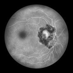 Retinal scar caused by a Toxoplasma gondii infection, or toxoplasmosis, scientific illustration