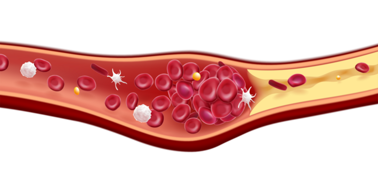 3D illustration of red blood cells and cholesterol clots cause death. Used in education, science and medical industry.