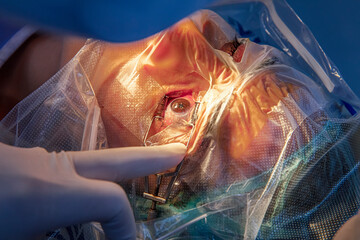 Laser vision correction. A patient and team of surgeons in the operating room during ophthalmic surgery. Patient under sterile lid.Ophthalmology surgery for eyes with laser correction for vision. - obrazy, fototapety, plakaty