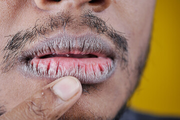 Close up of a young men hand dry lips 
