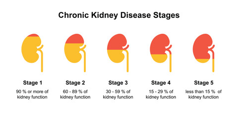 Scientific Designing of Chronic Kidney Disease (CKD) Stages. Vector Illustration.