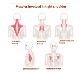 Muscle sets in the back that cause tight shoulder